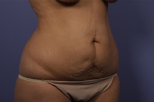 Tummy Tuck