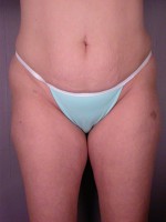 Tummy Tuck