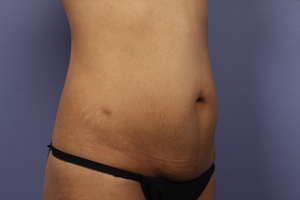 Tummy Tuck