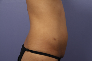 Tummy Tuck