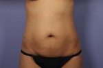 Tummy Tuck