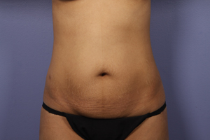 Tummy Tuck