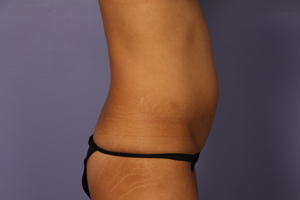 Tummy Tuck