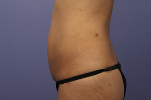 Tummy Tuck