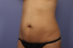 Tummy Tuck