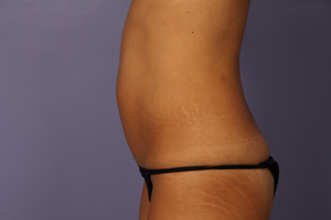 Tummy Tuck