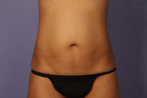 Tummy Tuck