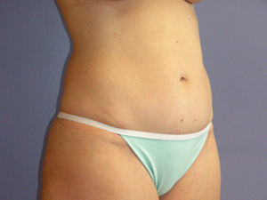 Tummy Tuck