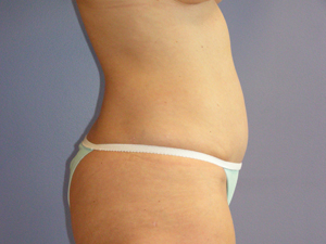 Tummy Tuck