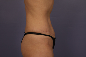 Tummy Tuck