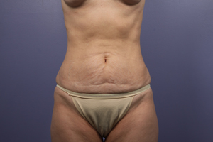 Tummy Tuck