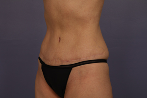 Tummy Tuck