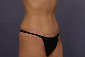 Tummy Tuck