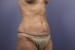 Tummy Tuck