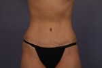 Tummy Tuck