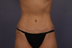 Tummy Tuck