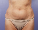 Tummy Tuck