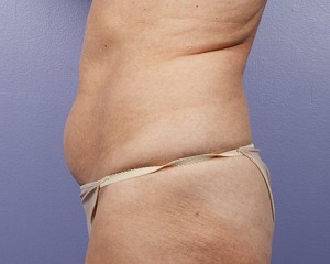 Tummy Tuck