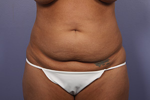 Tummy Tuck