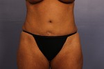 Tummy Tuck