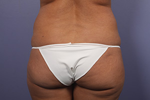 Tummy Tuck