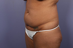 Tummy Tuck