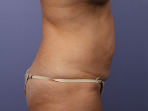 Tummy Tuck