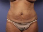 Tummy Tuck