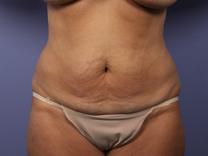 Tummy Tuck