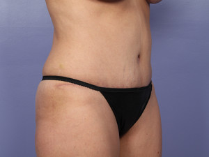 Tummy Tuck