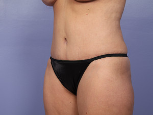 Tummy Tuck