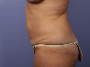 Tummy Tuck