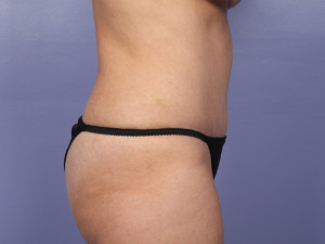 Tummy Tuck