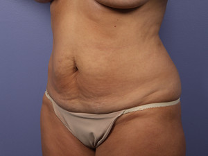 Tummy Tuck