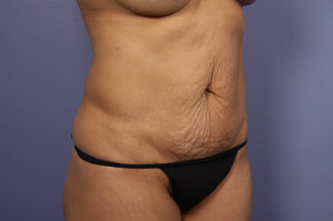 Tummy Tuck