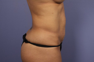 Tummy Tuck