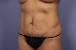 Tummy Tuck