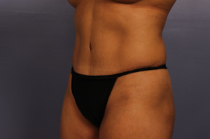 Tummy Tuck