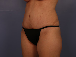 Tummy Tuck