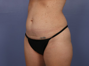 Tummy Tuck