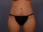 Tummy Tuck