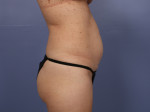 Tummy Tuck