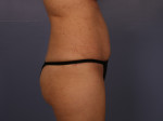 Tummy Tuck