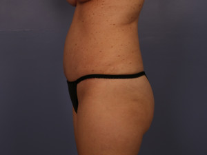 Tummy Tuck