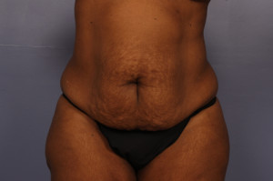 Tummy Tuck