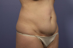 Tummy Tuck