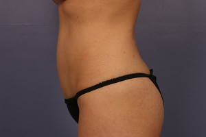 Tummy Tuck