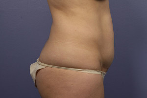 Tummy Tuck