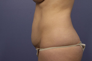 Tummy Tuck